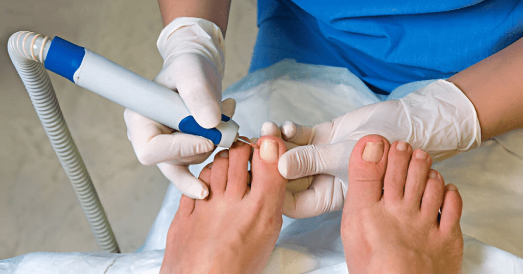 Close-up of an ingrown toenail being treated by a podiatrist Sole foot and ankle