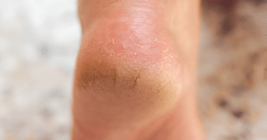 Cracked Heels Symptoms, Causes, and Treatment Sole Foot doc, Indiana