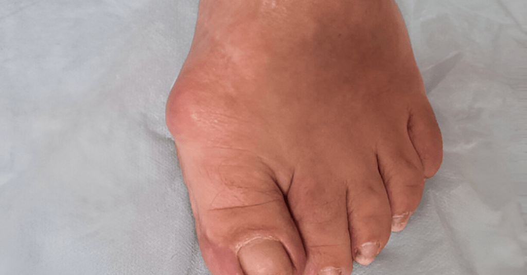 Lipomas on feet diagnosed at Valparaiso podiatry clinic Sole Foot Doctor