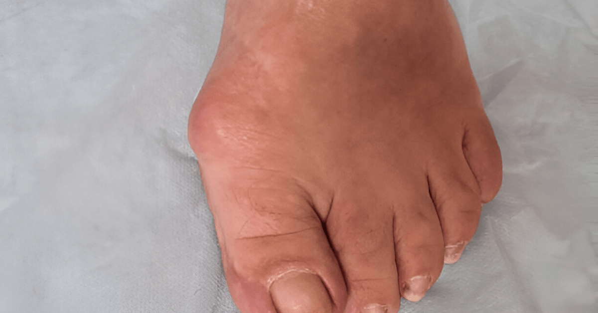 Lipomas on Feet: Causes, Symptoms, and Treatment Options