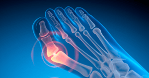 Can You Straighten a Bunion Without Surgery? | Sole Foot and Ankle | Sole Foot Doc | Podiatrist Valparaiso IN
