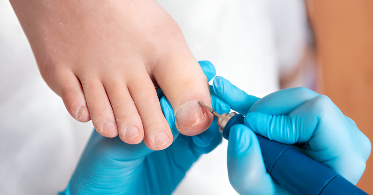 How to Fix Ingrown Toenails