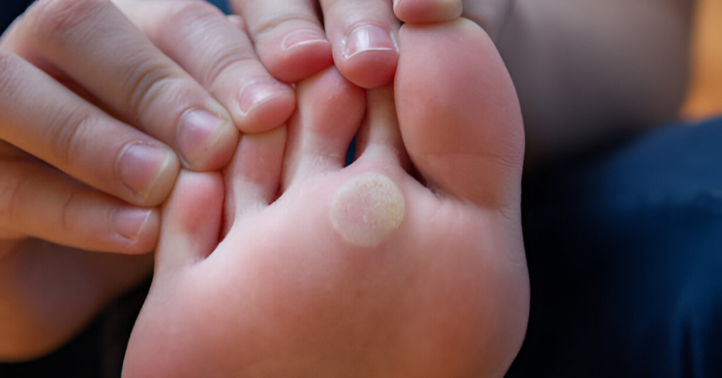 Plantar Warts Causes, Treatment, and Removal Sole Foot and Ankle Sole Foot Doc Podiatrist Valparaiso IN