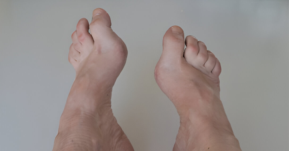 What Are Hammertoes and How Are They Treated?