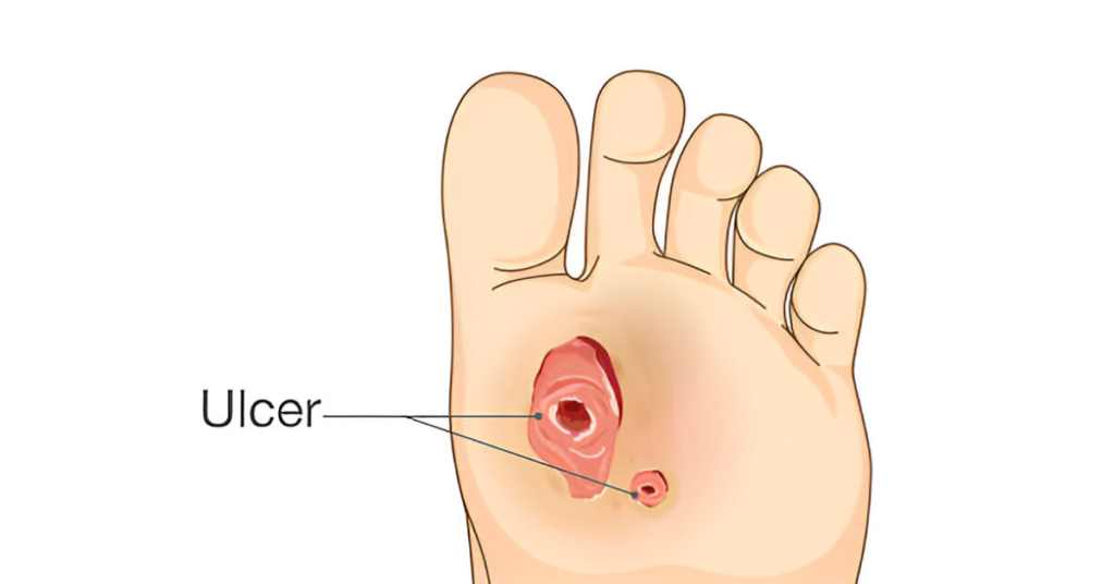Foot Ulcer Causes, Symptoms, & Treatment Sole Foot and Ankle Sole Foot Doc foot doctor in Podiatrist Valparaiso IN