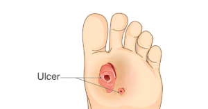 Foot Ulcer Causes, Symptoms, & Treatment Sole Foot and Ankle Sole Foot Doc foot doctor in Podiatrist Valparaiso IN