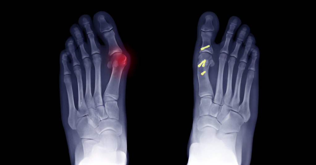 Osteotomy Surgery Meaning, Procedure & Recovery Sole Foot and Ankle Sole Foot Doc foot doctor in Podiatrist Valparaiso IN