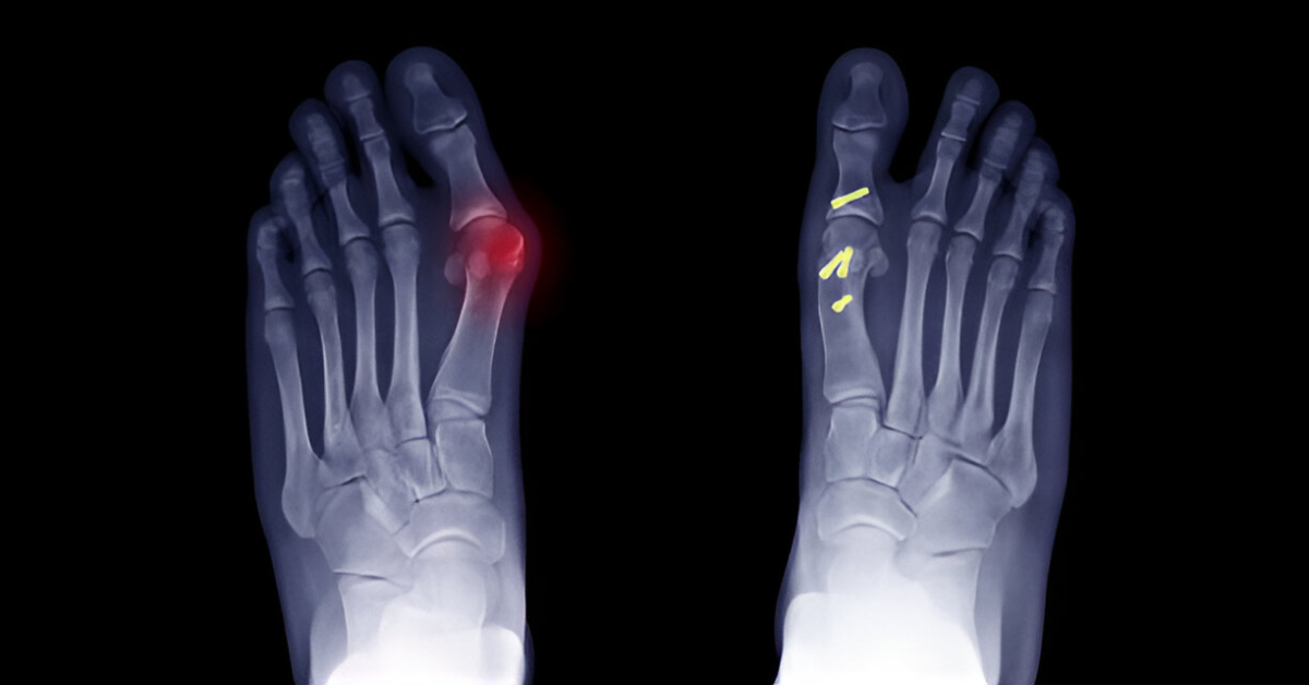 Osteotomy Surgery: Meaning, Procedure & Recovery