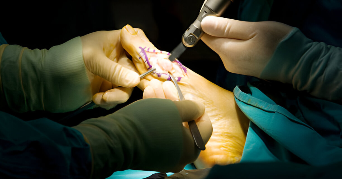 What Is Bunionectomy with Osteotomy?