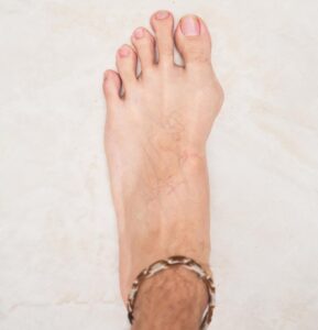 Bunions and Hammertoes Treatment in Valparaiso - Sole Foot Doc