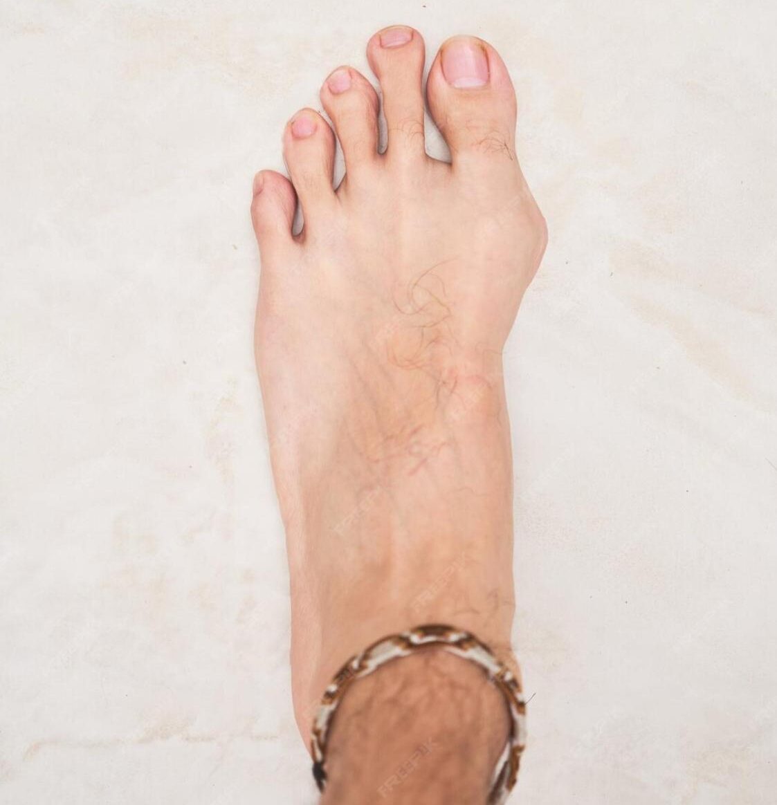 Bunions and Hammertoes Treatment in Valparaiso - Sole Foot Doc