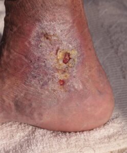 Diabetic Foot Ulcer Treatment in Valparaiso, Indiana | Sole Foot Doc