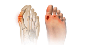 Are Bunions and Corns the Same Thing Sole Foot and Ankle Sole Foot Doc foot doctor in Podiatrist Valparaiso IN Valparaiso podiatrist podiatrist Valparaiso Indiana podiatrist Valparaiso