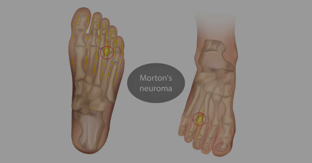 Morton's Foot Syndrome Causes, Symptoms & Treatment Sole Foot Doc foot doctor in Podiatrist Valparaiso IN Valparaiso podiatrist podiatrist Valparaiso Indiana podiatrist Valparaiso