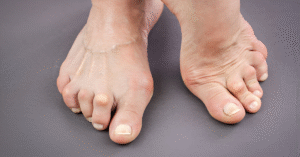 Rheumatoid Arthritis Symptoms, Causes and Treatment Sole Foot and Ankle Sole Foot Doc foot doctor in Podiatrist Valparaiso IN Valparaiso podiatrist podiatrist Valparaiso Indiana podiatrist