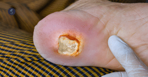 Why Diabetic Foot Ulcer Occur Sole Foot and Ankle Sole Foot Doc foot doctor in Podiatrist Valparaiso IN Valparaiso podiatrist podiatrist Valparaiso Indiana podiatrist Valparaiso