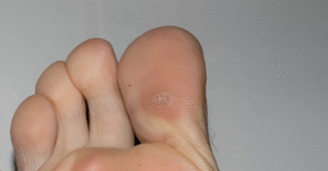 Are Plantar Warts Contagious Sole Foot Doc foot doctor in Podiatrist Valparaiso IN Valparaiso podiatrist podiatrist Valparaiso Indiana podiatrist Valparaiso