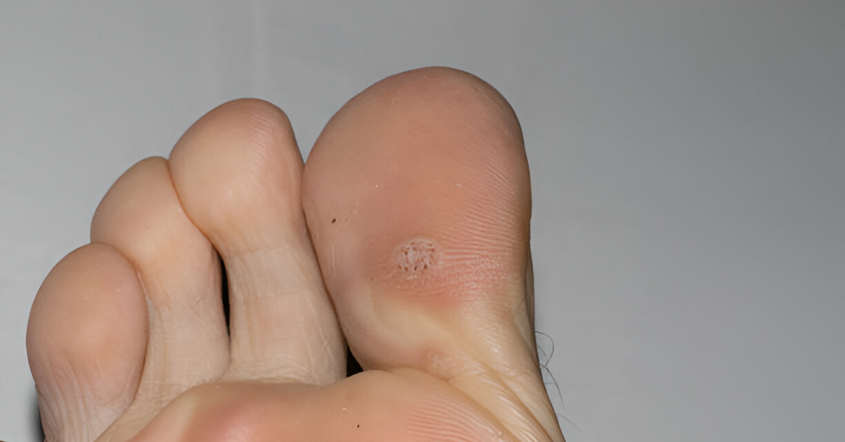 Are Plantar Warts Contagious?
