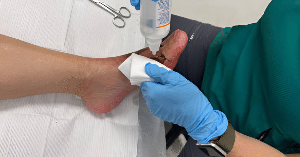 Can Bunion Surgery Cause Nerve Damage? | Sole Foot Doc | foot doctor in Podiatrist Valparaiso IN | Valparaiso podiatrist | podiatrist Valparaiso Indiana | podiatrist Valparaiso