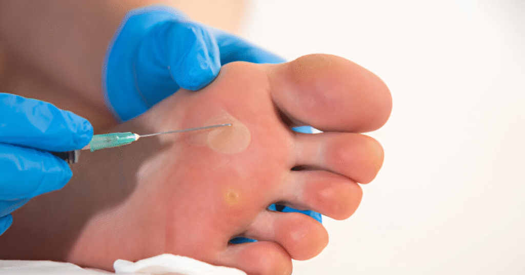 How to Prevent the Spread of Plantar Warts Sole Foot Doc foot doctor in Podiatrist Valparaiso IN Valparaiso podiatrist podiatrist Valparaiso Indiana podiatrist Valparaiso