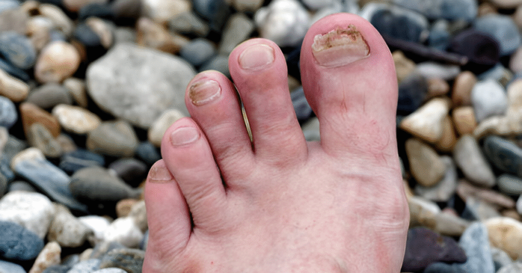 Toenail Fungus Causes, Symptoms & Treatment Sole Foot Doc foot doctor in Podiatrist Valparaiso IN Valparaiso podiatrist podiatrist Valparaiso Indiana podiatrist Valparaiso