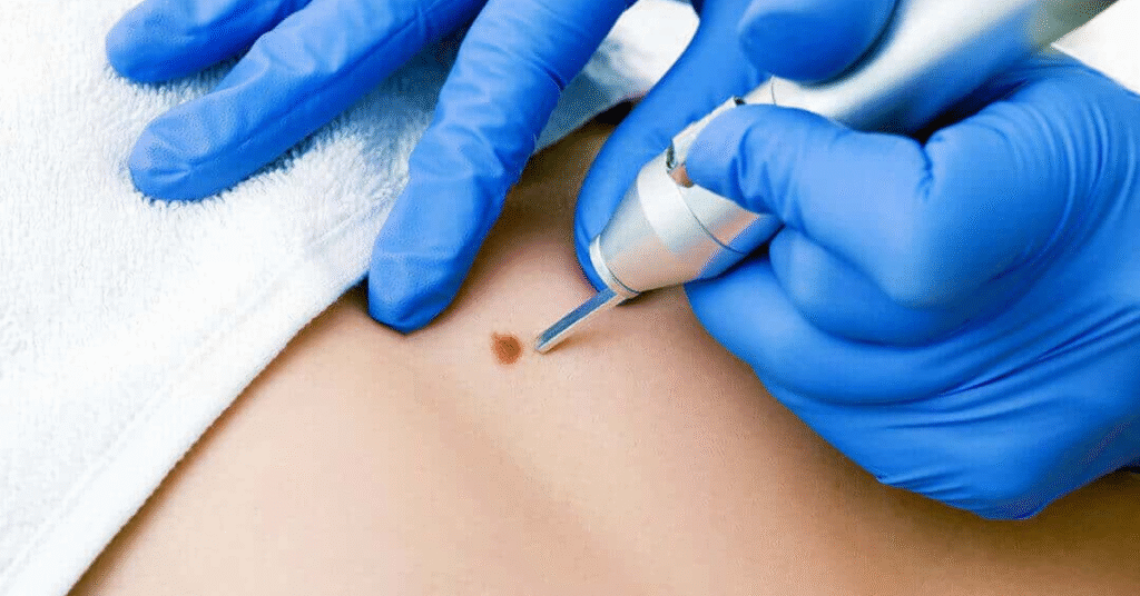 Non-Surgical Solutions for Morton’s Neuroma and Metatarsalgia Sole Foot and Ankle Valparaiso Sole Foot Doc foot doctor in Podiatrist Valparaiso IN Valparaiso podiatrist podiatrist Valparai