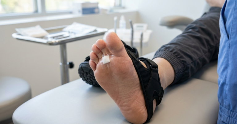 5 Reasons to Consider MIS Hammertoe Correction for Quick Mobility