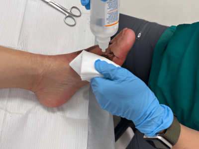 Bunion Treatment Valparaiso, painful toe joint relief, minimally invasive bunion surgery, Sole Foot and Ankle bunion care, hallux valgus treatment, toe realignment Indiana