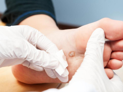 Foot neuropathy treatment Valparaiso, nerve pain relief, burning feet sensation solution, Sole Foot and Ankle nerve care, peripheral neuropathy clinic, numbness in feet relief