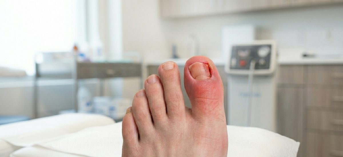 Can Ingrown Toenails Cause Sepsis Podiatrist Valparaiso IN Foot doctor Northwest Indiana Sole Foot & Ankle Valparaiso Best foot specialist in Valparaiso Emergency podiatrist near me Foot and a
