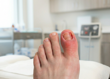 Can Ingrown Toenails Cause Sepsis Podiatrist Valparaiso IN Foot doctor Northwest Indiana Sole Foot & Ankle Valparaiso Best foot specialist in Valparaiso Emergency podiatrist near me Foot and a