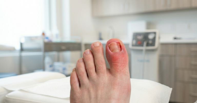 Can Ingrown Toenails Cause Sepsis?