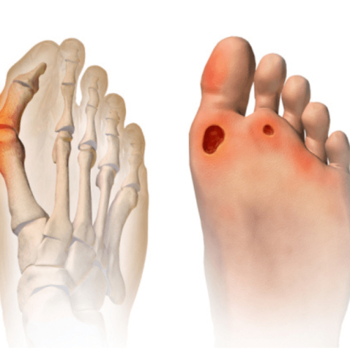 Are Bunions and Corns the Same Thing Sole Foot and Ankle Sole Foot Doc foot doctor in Podiatrist Valparaiso IN Valparaiso podiatrist podiatrist Valparaiso Indiana podiatrist Valparaiso