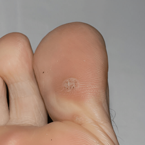 Are Plantar Warts Contagious Sole Foot Doc foot doctor in Podiatrist Valparaiso IN Valparaiso podiatrist podiatrist Valparaiso Indiana podiatrist Valparaiso