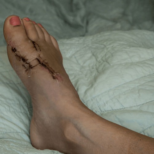 Can Bunion Surgery Cause Nerve Damage? | Sole Foot Doc | foot doctor in Podiatrist Valparaiso IN | Valparaiso podiatrist | podiatrist Valparaiso Indiana | podiatrist Valparaiso