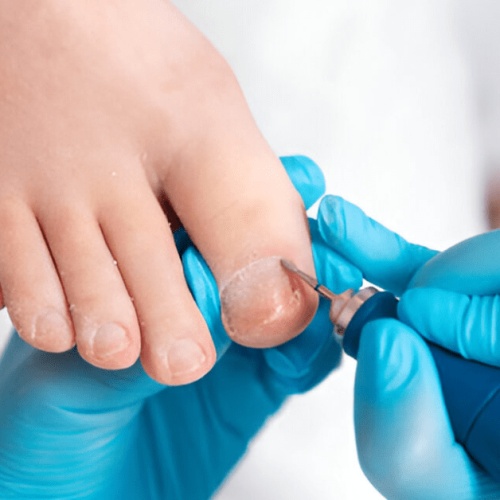 Can Ingrown Toenails Heal Themselves Sole Foot and Ankle Sole Foot Doc foot doctor in Podiatrist Valparaiso IN Valparaiso podiatrist podiatrist Valparaiso Indiana podiatrist Valparaiso