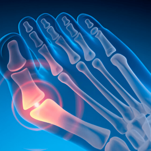 Can You Straighten a Bunion Without Surgery? | Sole Foot and Ankle | Sole Foot Doc | Podiatrist Valparaiso IN