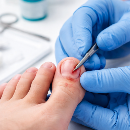 Can an Ingrown Toenail Kill You Sole Foot and Ankle Valparaiso Sole Foot Doc foot doctor in Podiatrist Valparaiso IN Valparaiso podiatrist podiatrist Valparaiso Indiana podiatrist Valpara