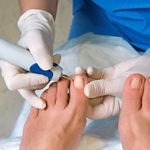Close-up of an ingrown toenail being treated by a podiatrist Sole foot and ankle