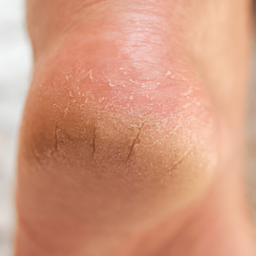 Cracked Heels Symptoms, Causes, and Treatment Sole Foot doc, Indiana