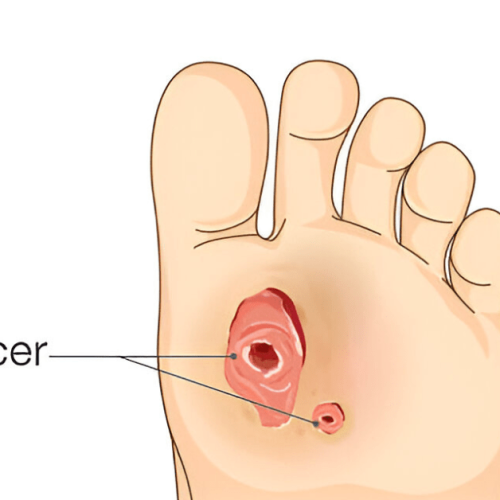 Foot Ulcer Causes, Symptoms, & Treatment Sole Foot and Ankle Sole Foot Doc foot doctor in Podiatrist Valparaiso IN