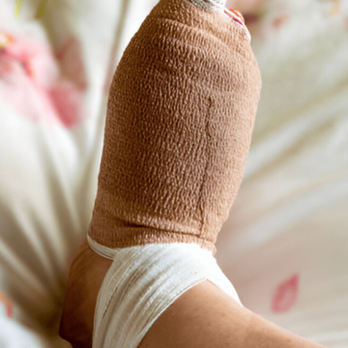 Is Bunion Surgery an Outpatient Procedure Sole Foot and Ankle ,Valparaiso, Indiana