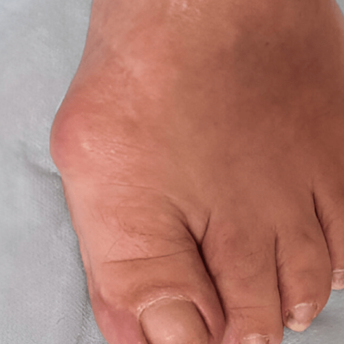 Lipomas on feet diagnosed at Valparaiso podiatry clinic Sole Foot Doctor