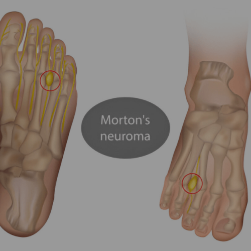 Morton's Foot Syndrome Causes, Symptoms & Treatment Sole Foot Doc foot doctor in Podiatrist Valparaiso IN Valparaiso podiatrist podiatrist Valparaiso Indiana podiatrist Valparaiso