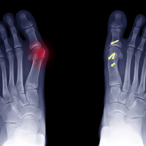 Osteotomy Surgery Meaning, Procedure & Recovery Sole Foot and Ankle Sole Foot Doc foot doctor in Podiatrist Valparaiso IN