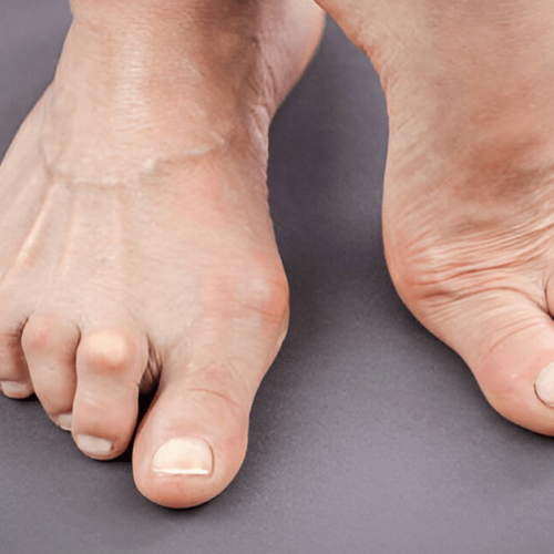 Rheumatoid Arthritis Symptoms, Causes and Treatment Sole Foot and Ankle Sole Foot Doc foot doctor in Podiatrist Valparaiso IN Valparaiso podiatrist podiatrist Valparaiso Indiana podiatrist