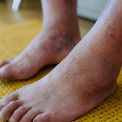 The Top 5 Mistakes to Avoid in Diabetic Foot Care | Sole Foot and Ankle | Sole Foot Doc | foot doctor in Podiatrist Valparaiso IN