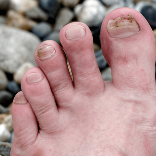 Toenail Fungus Causes, Symptoms & Treatment Sole Foot Doc foot doctor in Podiatrist Valparaiso IN Valparaiso podiatrist podiatrist Valparaiso Indiana podiatrist Valparaiso