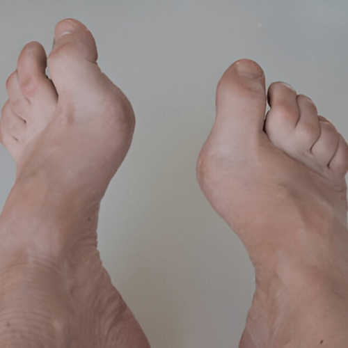 What Are Hammertoes and How Are They Treated Sole Foot and Ankle Sole Foot Doc Podiatrist Valparaiso IN