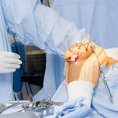 What Is Arthrodesis Surgery and How Does It Work Sole Foot and Ankle Sole Foot Doc foot doctor in Podiatrist Valparaiso IN